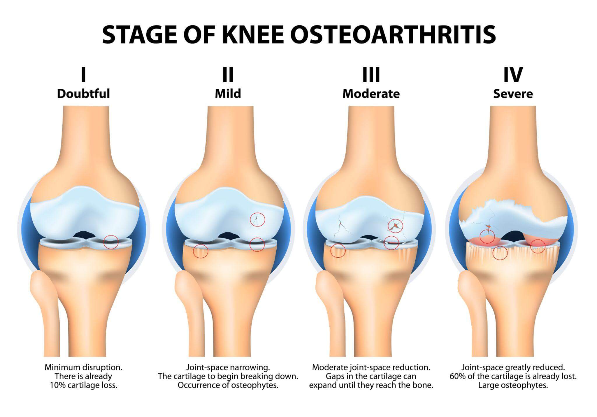 Stage of knee osteoarthritis