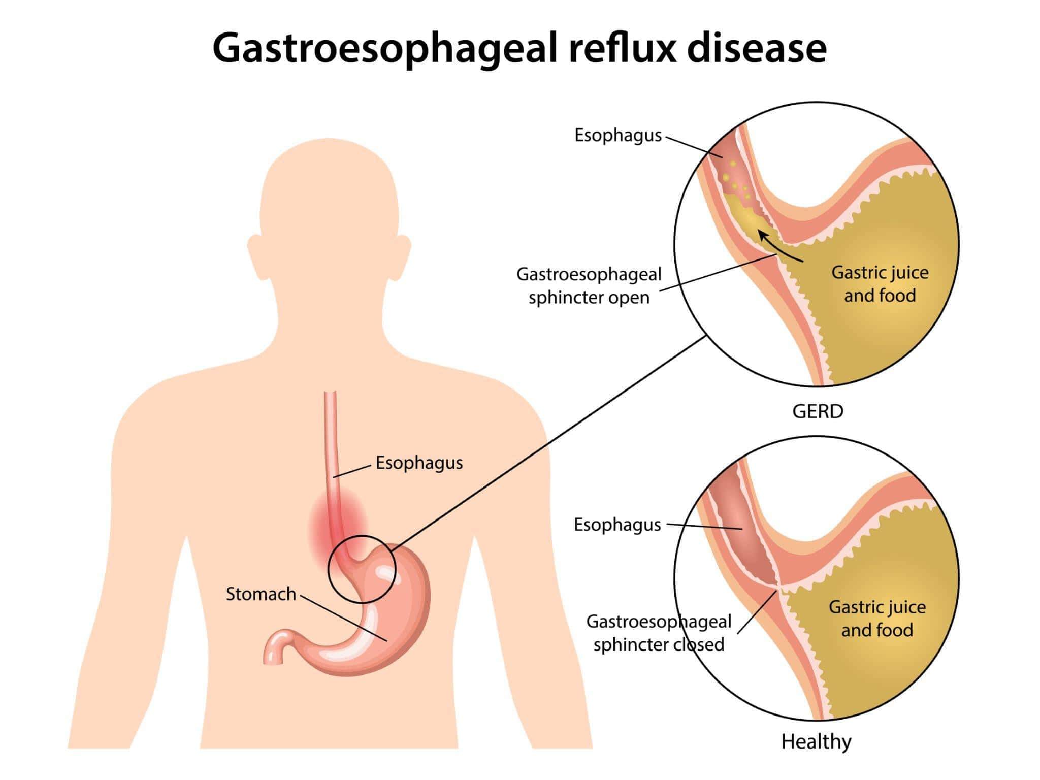 Gastroesophageal reflux disease
