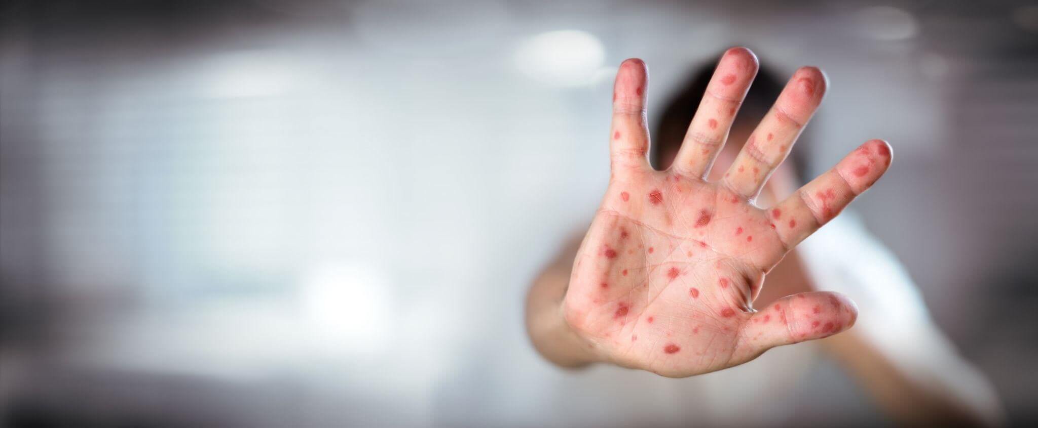 spots on a hand indicating measles or chickenpox